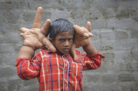 This 8 Year Boy With Unusual GIANT HANDS Will Puzzle You