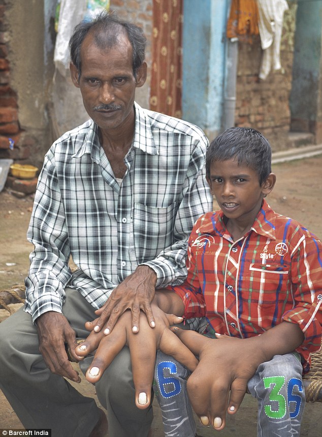 Kaleem, boy with big hands, India